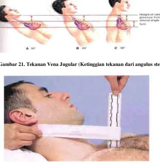 Gambar 22. Pengukuran Tekanan Vena Jugular (Jugular Venous Pressure/JVP)  Perhatikan  apakah  ada  bendungan  pada  vena  jugularis