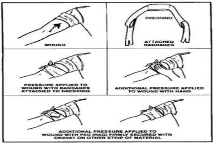 Gambar 1. Teknik pelaksanaan penekanan langsung dan balut tekan 