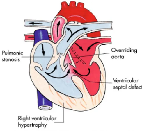 Gambar 1. Tetralogy of Fallot