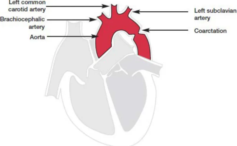 Gambar 2.7. Koarktasio Aorta (Ashley &amp; Niebauer, 2004)  2.2.4.2. Penyakit Jantung BawaanSianotik 