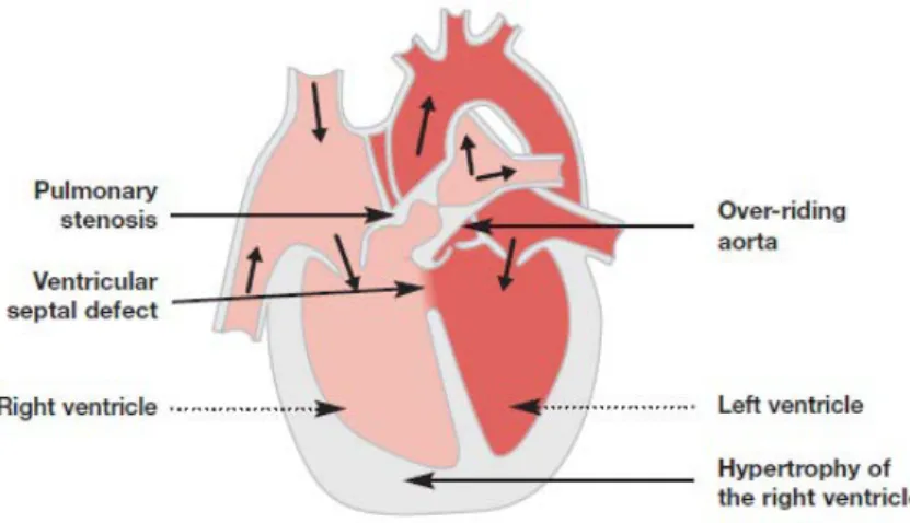 Gambar 2.8. Tetralogi Fallot (Ashley &amp; Niebauer, 2004) 