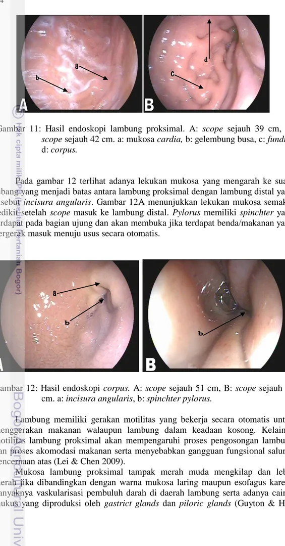 Gambar 12:  Hasil endoskopi  corpus. A:  scope sejauh 51 cm, B:  scope sejauh 69  cm. a: incisura angularis, b: spinchter pylorus