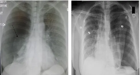 Foto Rö pneumotoraks (PA), bagian yang ditunjukkan dengan anak panah merupakan bagian paru yang kolaps