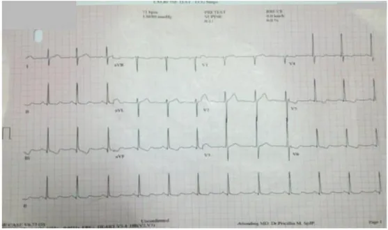 Gambar 1. EKG dalam posisi supine, menunjukan adanya HVKi dengan  teknik penilaian Sokolow lyon.(Sumber : RSUD) 