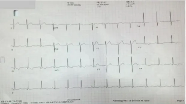 Gambar EKG 2. saat posisi standing menunjukan irama sinus dengan  kriteria adanya HVKi.(Sumber : RSUD) 