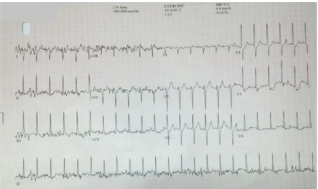 Gambar 4. EKG pada posisi peak exercise stage 2, dihentikan karena  pasien kelelahan. (Sumber : RSUD) 