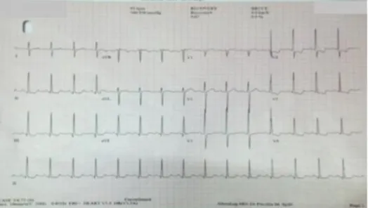 Gambar 7 EKG saat recovery pada menit ke 9:07, gambaran EKG  mendekati resting awal (Sumber : RSUD) 