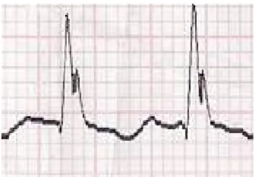 Gambar 2.4 Contoh analisa dari kertas EKG Analisa dari gambar 2.4 adalah B, dengan nilai tPR antara 0.12 – 0.2, tRR antara 0.45 – 0.69 dan mengandung gangguan.