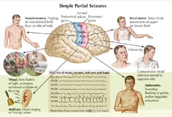 Gambar 3. Manifestasi Epilepsi Parsial Sederhana (ELSEVIER- (ELSEVIER-netterimages.com)