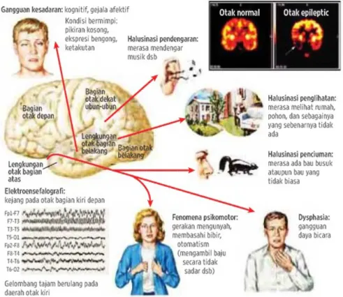 Gambar 4. Manifestasi Epilepsi Parsial Kompleks (ELSEVIER-netterimages.com)   