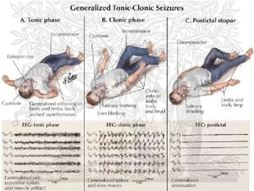 Gambar 5. Epilepsi tonik-klonik umum (ELSEVIER-netterimages.com)