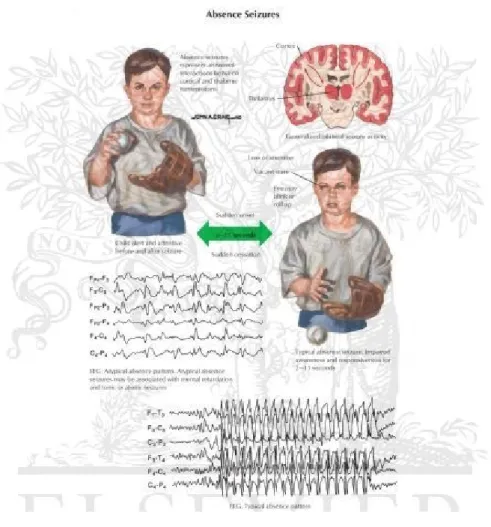 Gambar 7.  Epilepsi Absence (Petit Mal Seizure) (ELSEVIER-netterimages.com)