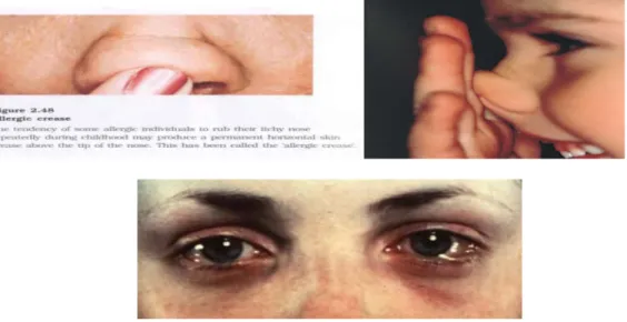 Gambar 3. Gambaran klinis Rinitis Alergi