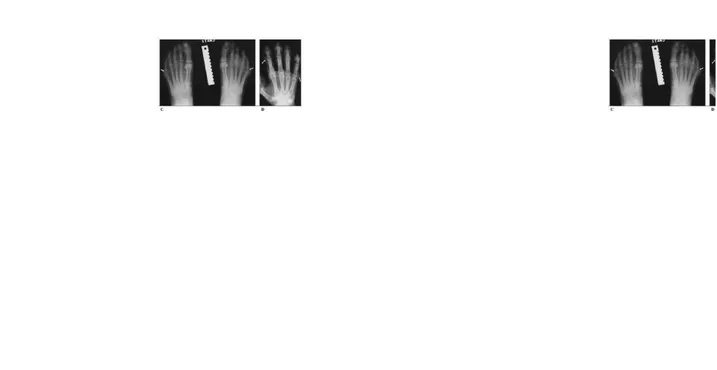 Gambar  5.  (C)  Swelling  dan  erosi  pada  sendi  MTP  5.  (D)  Nodul  subkutaneus multipel pada tangan