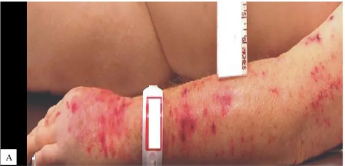 Gambar 1. Gambaran klinis Intravascular lymphomapada kulit (lesi purpura di lengan). 6 