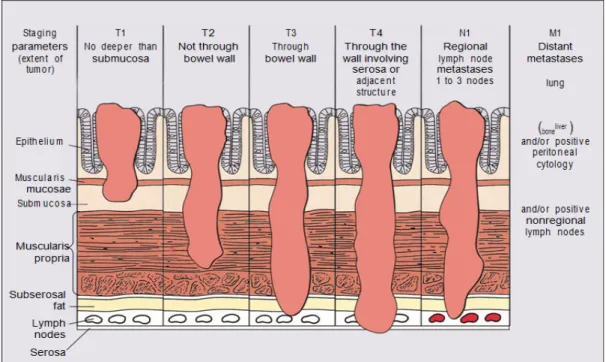 Gambar 2.6 Klasifikasi stadium kanker usus besar menurut Dukes. Tahapan B3 dan C3 (tidak  ditunjukkan) menandakan perforasi atau invasi organ atau struktur yang berdekatan (Niederhuber  et al, 2016) 