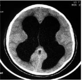 Gambar 3. MRI kepala dengan hidrosefalus 