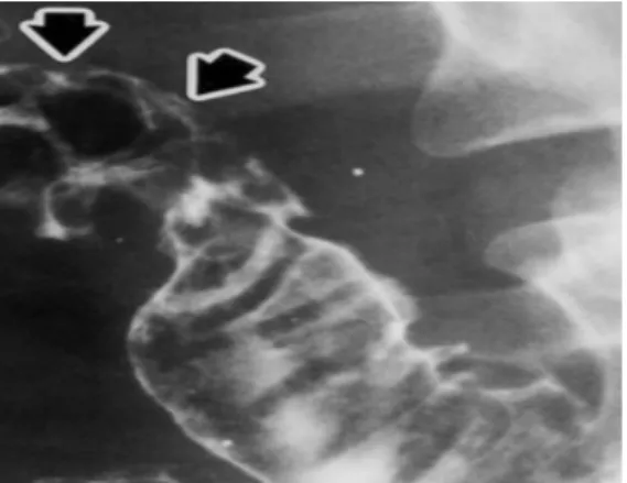 Gambar  4. Penyakit Crohn: Usus kecil dengan gambaran”cobblestoning”  pada bagian ileum terminal.