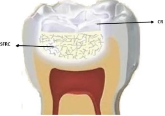 Gambar 11. Skematik biomimetic berlapis dentin yang hilang digantikan dengan short fiber reinforced  komposit (Garaoushi et al 2017)