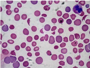 Gambar 4: Anemia hemolitik autoimun 
