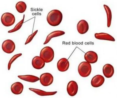 Gambar 8: Anemia sel sabit dengan sickle cells 