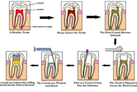 Gambar 8. Tahap-tahap pulpotomi devital (Mumifikasi)  Sumber:  http://www.dentiadental.com/home/dentist-team.html