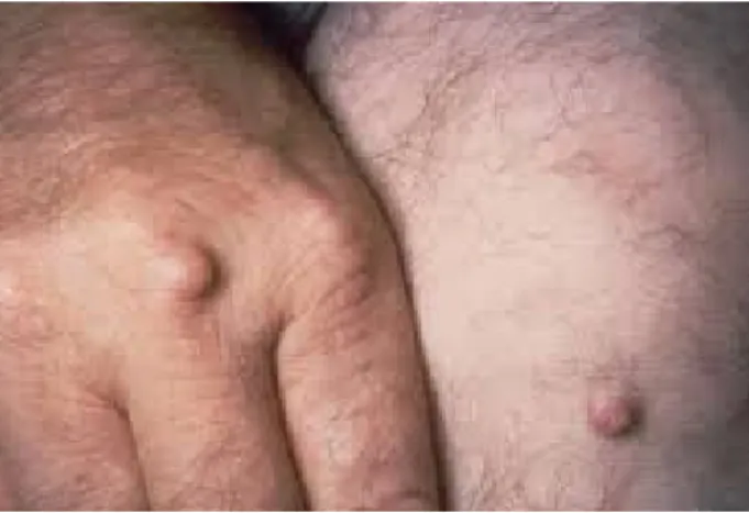 Gambar 2. Xanthomas tuberous