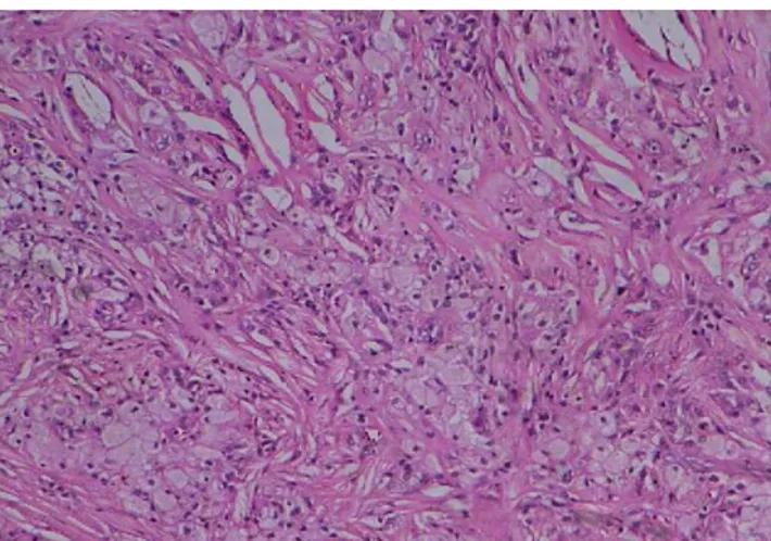Gambar 5. gambaran histologipatologi xanthoma menunjukkan sel busa penuh lemak dengan adanya area celah yang besar menunjukkan kolesterol 