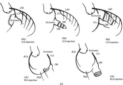 Gambar 2.5. Suplai kolateral ke tiga arteri koroner utama. a) kolateral yang berkembang  pada  oklusi  left anterior descending  (LAD),  b)  kolateral  yang  berkembang  pada  oklusi  right  coronary  artery  (RCA)  dan  c)  kolateral  yang  berkembang  pa