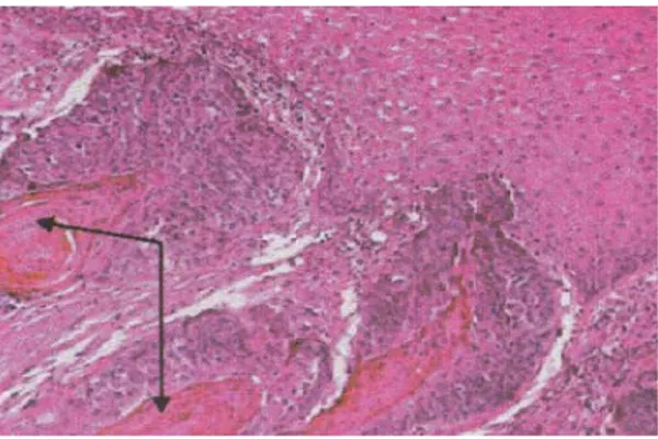 Gambar 8: Histopatologis SCC well differentiated. Terlihat proliferasi sel-sel                       Skuamosa  disertai pembentukan keratin (keratin pearl) (tanda                      panah) 