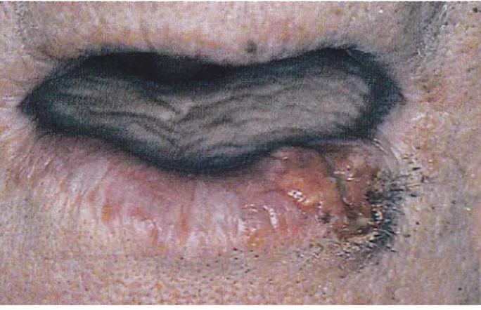 Gambar 4: Karsinoma sel skuamosa pada bibir 