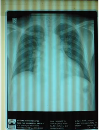 Gambar 2. Rontgen Thorax 