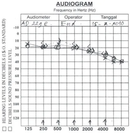 Gambar 1. Hasil audiogram