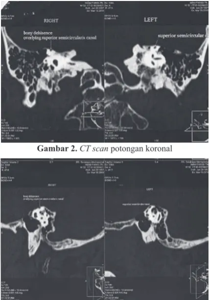 Gambar 2. CT scan potongan koronal  