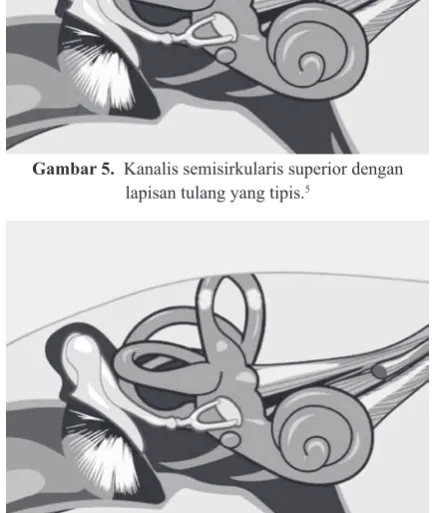 Gambar 5.  Kanalis semisirkularis superior dengan 