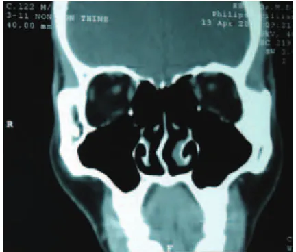 Gambar 1. Tomografi komputer sinus paranasal potongan koronal terlihat deviasi septum ke kanan