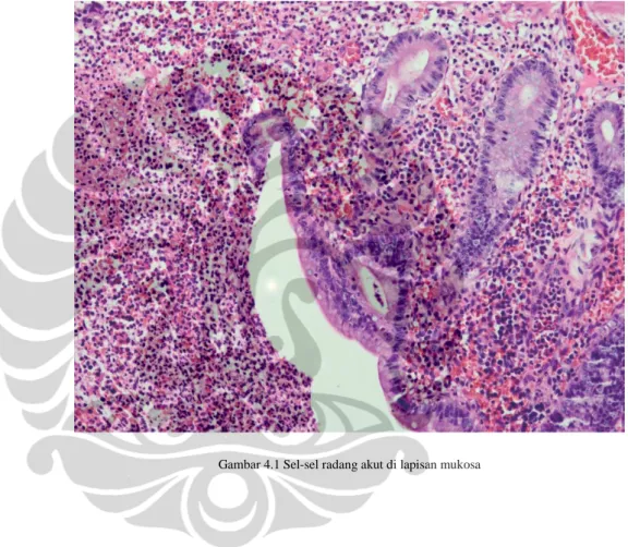 Gambar 4.1 Sel-sel radang akut di lapisan mukosa 