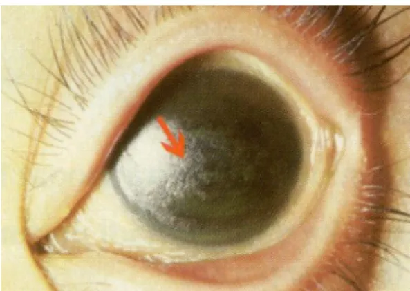 Gambar 6. Xerosis Kornea 