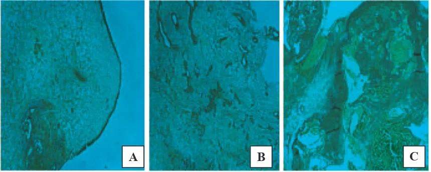 Gambar 2. Polip edematosa disertai hemangioma kapilare dan kavernosum (A) Jaringan berbentuk polipoid berlapiskan epitel torak bertingkat bersilia