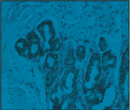 Gambar 2. COX-2 ditemukan positif/overekspresi lapisan apikal epitel (dengan menggunakan mikroskop Olympus BH-2, pembesaran 20 x 40/ No