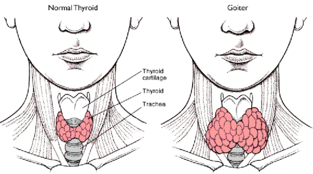 gambar 1: kelenjar tiroid normal dan yang membesar 1