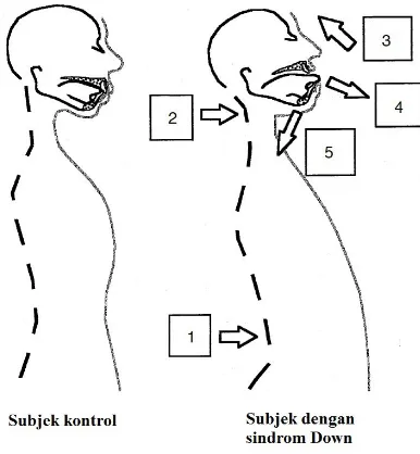 Gambar 1.  Posisi mandibula.Mandibula lebih rendah, posisi lidah lebih anterior gigi geligi, dan bibir tidak menutup