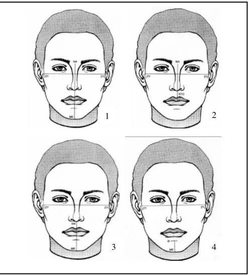 Gambar 6.  Pengukuran foto frontal (1) Facial Index (2) Upper Facial Index (3) Lower Facial Index (4) Chin Index19 