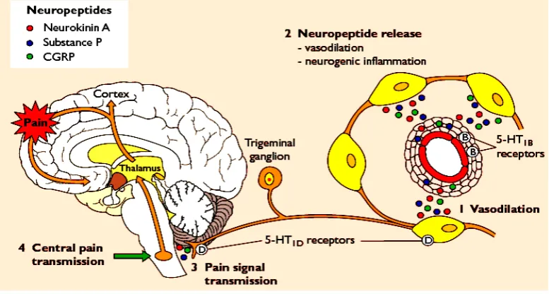 Gambar 1. Postulat Mekanisme Patofisiologi Migren 