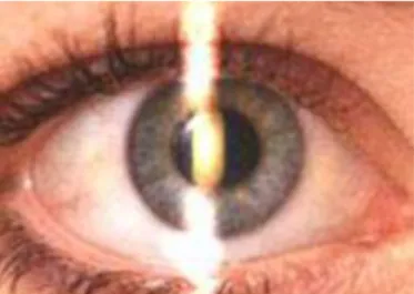 Gambar 5. Hand held instrument yang disebut sebagai retinoskop memproyeksikan  berkas cahaya ke mata selama retinoskopi 7