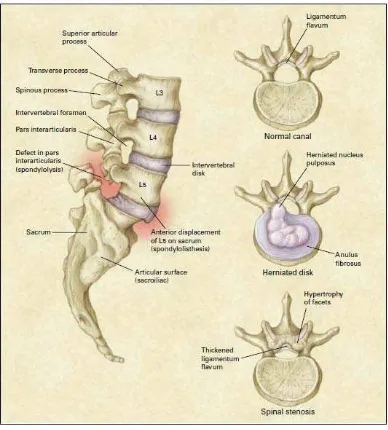 Gambar 1. Kondisi pathoanatomical yang umum dijumpai pada lumbal  