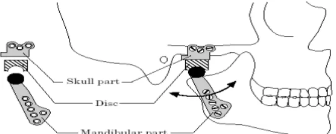 Gambar  2.    Posisi  komponen-komponen  Groningen  temporomandibular  joint  prosthesis pada tengkorak manusia 
