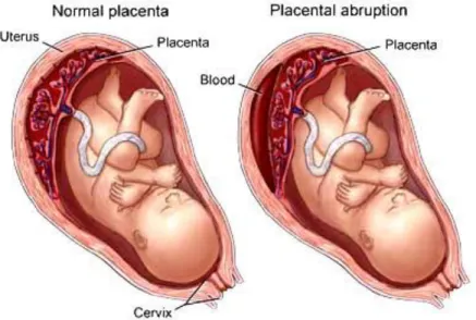 gambar plasenta normal dan solusio plasenta 