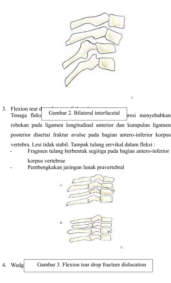 Gambar 2. Bilateral interfacetal dislocation