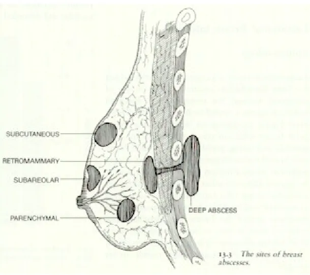 Gambar 2.3. lokasi abses pada mastitis